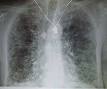 <b>Pulmonary fibrosis</b>