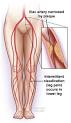 Peripheral Artery Disease (