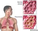 <b>pneumonia pneumocócica</b>.