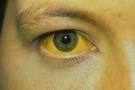 Identifying hepatitis infection - The Clinical Advisor