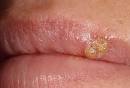 Lysine for Cold Sores