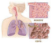 220px-Copd_versus_healthy_lung.jpg