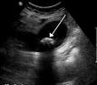 Gallstone - Wikipedia, the free encyclopedia