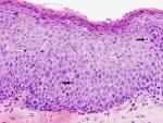 and <b>carcinoma</b> in <b>situ</b> are