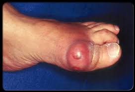  Gout Cures: What Tips are Available for Finding the Right Gout cures?