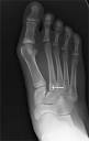 Advice on Foot Care » Lisfranc's Injury
