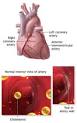 <b>Coronary</b> Artery Disease