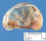 <b>Spermatocele</b>