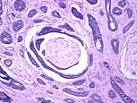 <b>adenoid cystic carcinoma</b>