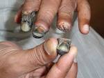 devoloped <b>gangrene</b> last