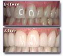 dental tooth whitening