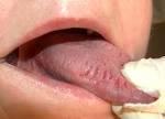 File:Fissured <b>tongue</b>.jpg