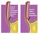 Bile Reflux