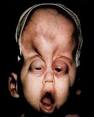 Birth defects