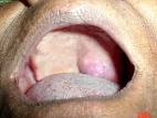 Picture 1 - <b>Adenoid Cystic</b>