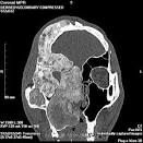 <b>fibrous dysplasia</b>