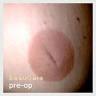 inverted nipple correction