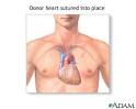 HEART TRANSPLANT - Series - Wake Forest Baptist Medical Center