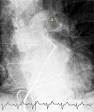 Pulmonary embolism - Wikipedia, the free encyclopedia
