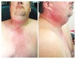 <b>Ludwig's Angina</b> — NEJM
