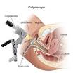 Tests and Procedures - Colposcopy | Johns Hopkins Medicine Health ...