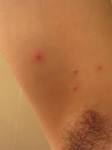 Red bumps in and around armpits, have pics to show