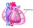 cardiac tamponade - definition of cardiac tamponade in the Medical ...