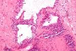 <b>serous cystadenoma</b> - high