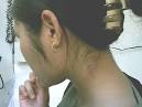 <b>Tuberculosis Ganglionar</b>: A