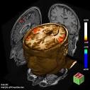 fmri <b>risonanza magnetica</b>