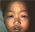cough, nasal congestion,