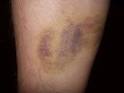 Bruised skin