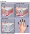 Frostbite Causes and Image