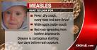 measles2.jpg