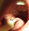 Infectious mononucleosis - Wikipedia, the free encyclopedia