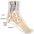 POSTERIOR Tibial Tendonitis