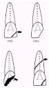 \Types of <b>tooth fractures</b>.