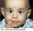 What is infantile <b>esotropia</b>?