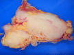 Follicular <b>lymphoma</b> replacing