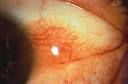 <b>Conjunctival</b> intraepithelial