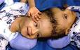 Two-year-old Egyptian twins, Ahmed and Mohammed Ibrahim, before they were ... - w