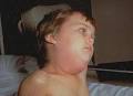 <b>Parotitis</b>.
