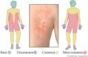 Allergic Skin Reactions - Health.