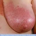 <b>Mastitis</b>