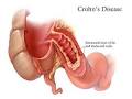 Inflamaciones: <b>enfermedad</b> de