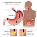 ESOPHAGEAL CANCER - Thomas Jefferson University Hospitals