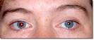 <b>anisocoria</b>_1.jpg