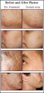  Home Acne Scars Treatment   Effective Remedies