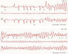 Cardiac Arrhythmias