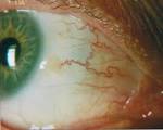 The conjunctiva/<b>sclera</b>.